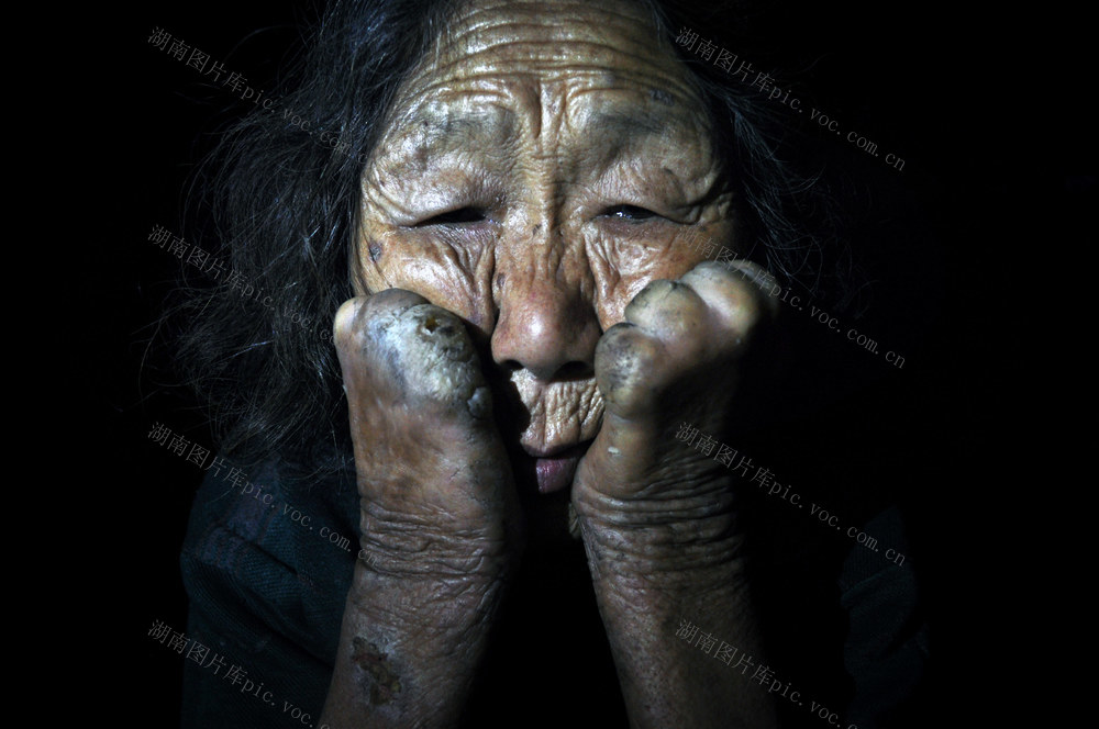  Leprosy patients in leprosy village